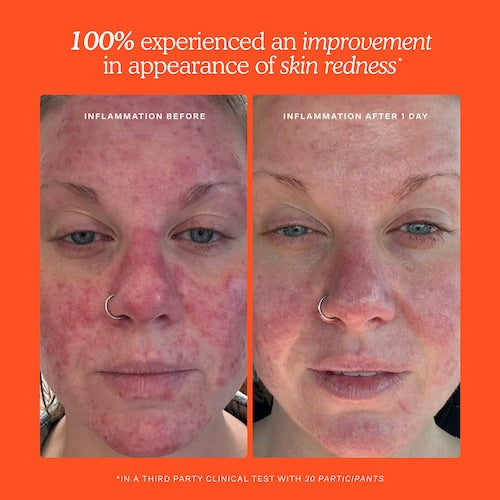 SOS Daily Hypochlorous Acid Spray for Breakouts & Redness - GLAM MODA