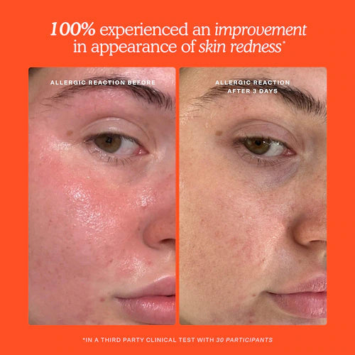 SOS Daily Hypochlorous Acid Spray for Breakouts & Redness - GLAM MODA