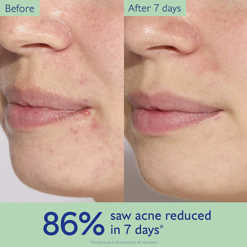 Vinopure Acne Serum to Treat and Prevent Blemishes - GLAM MODA