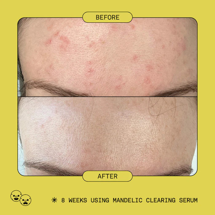 Mandelic Acid Exfoliating & Clearing Serum bottle angle view